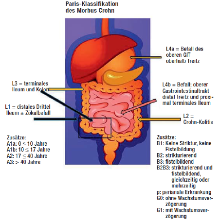 Darmerkrankungen: Paris Klassifikation des Morbus Crohn